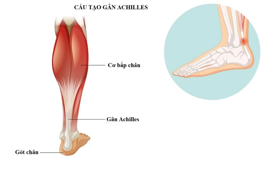 Viêm gân Achilles