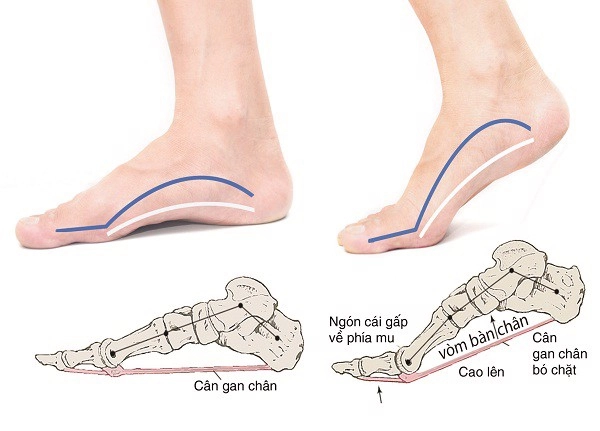 Chọn giày cầu lông theo hình dáng bàn chân